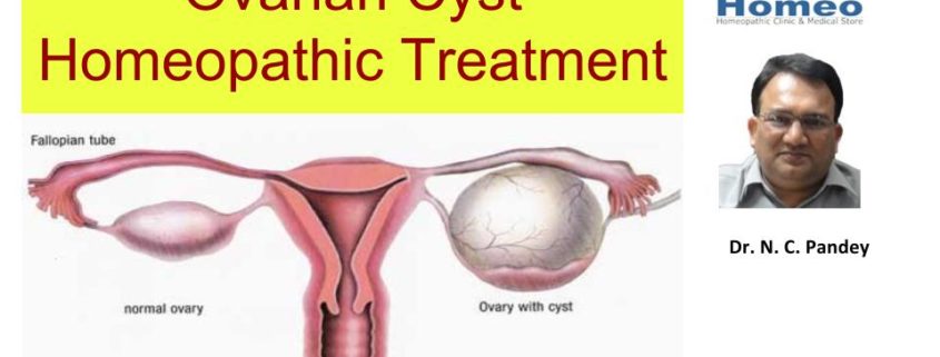 homeopathic treatment for Ovary Cyst