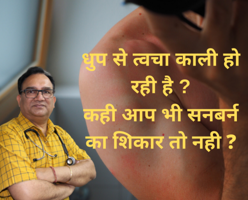 sunburn treatment in homeopathy