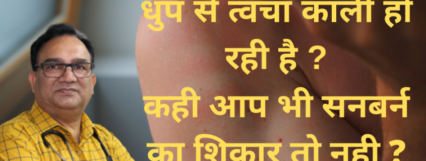 sunburn treatment in homeopathy