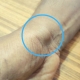 lipoma ka upchar