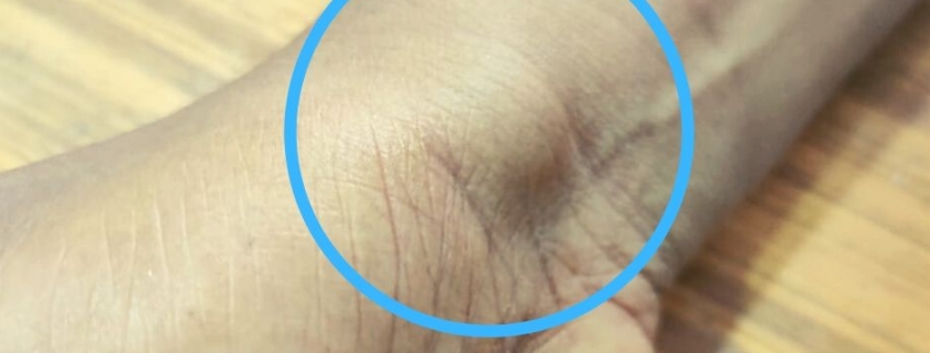 lipoma ka upchar