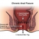 anel fissure treatment in homeopthy