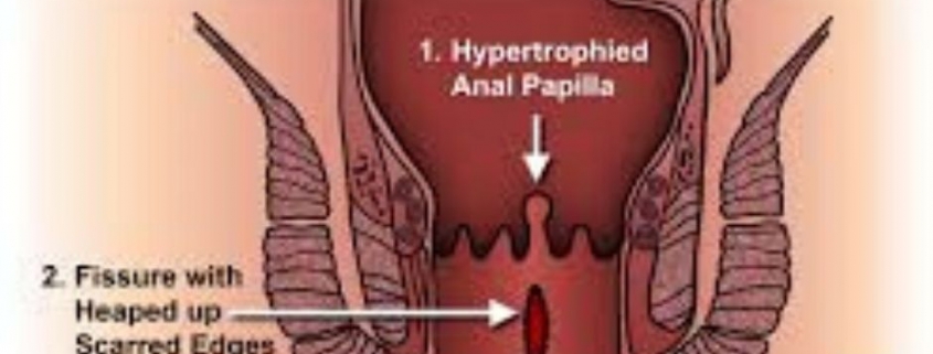 anel fissure treatment in homeopthy