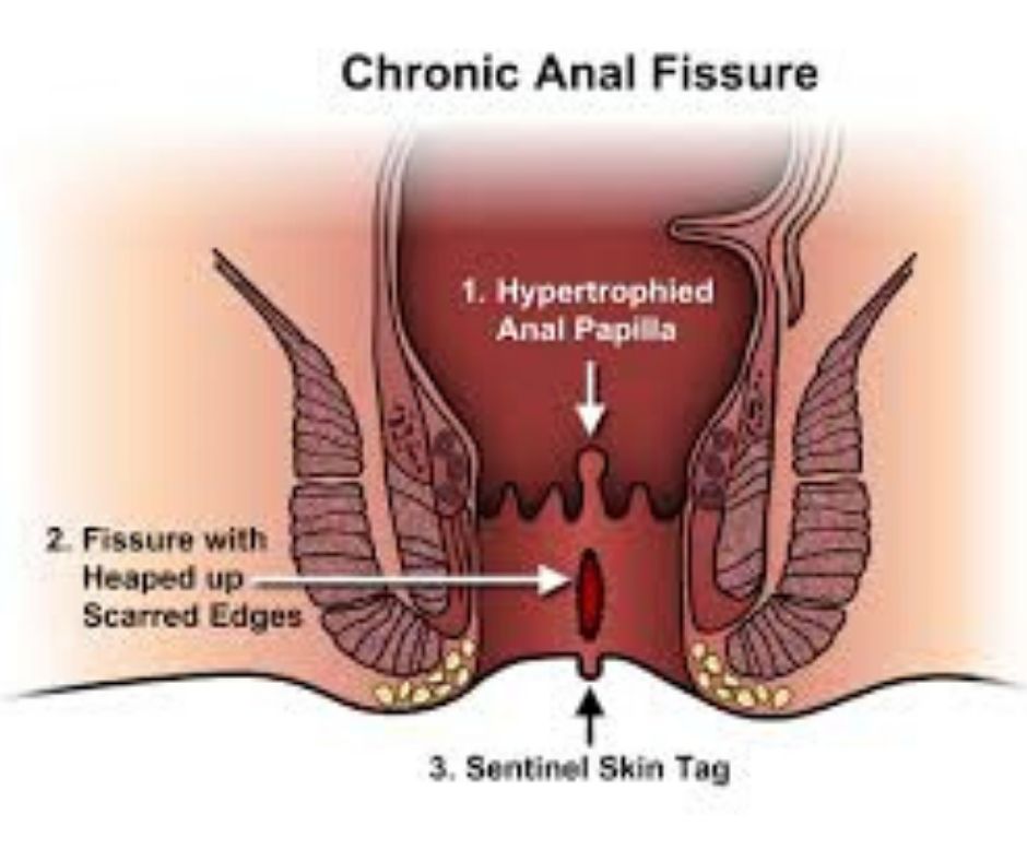 anel fissure treatment in homeopthy