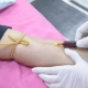 Tlc Test for white blood cell